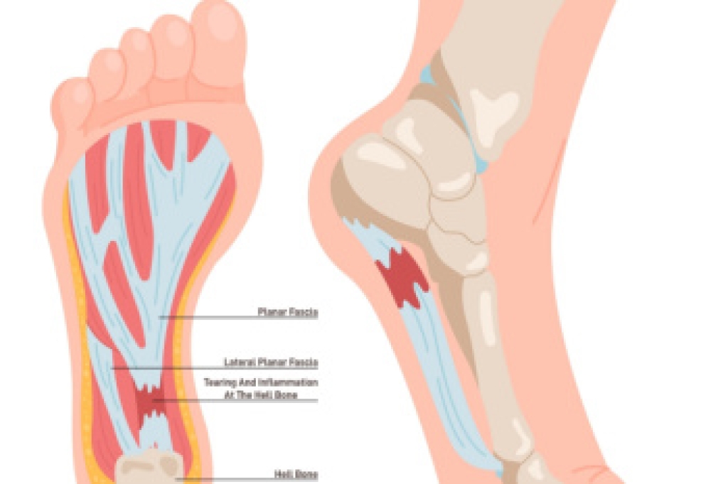 Potential Treatments for Plantar Fasciitis