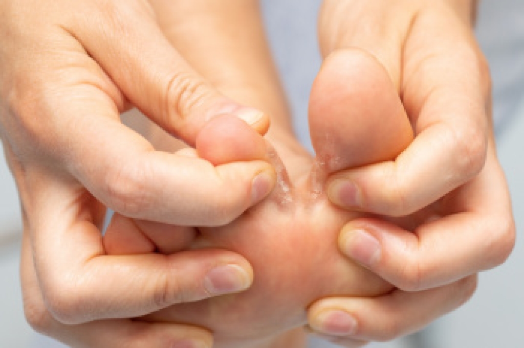 Athlete’s Foot and Podiatric Care