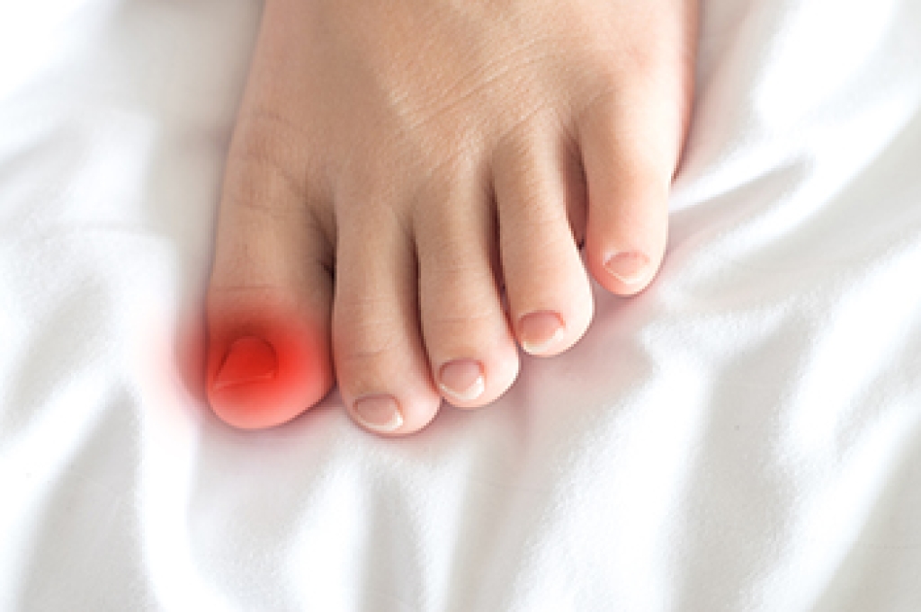 Causes and Symptoms of Ingrown Toenails