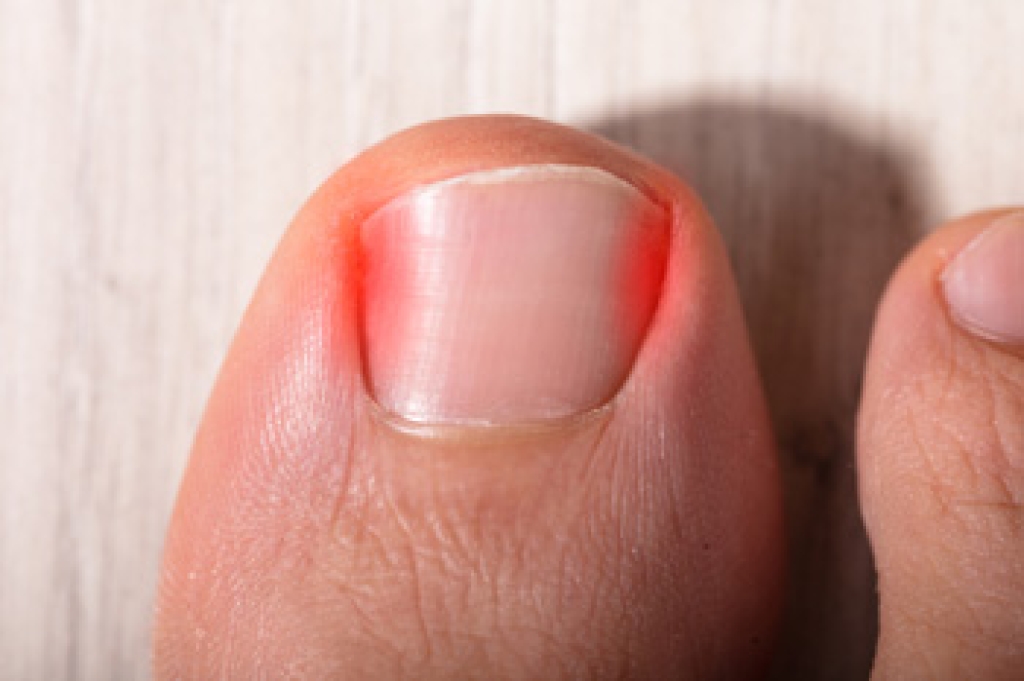 The Trouble With Painful Ingrown Toenails