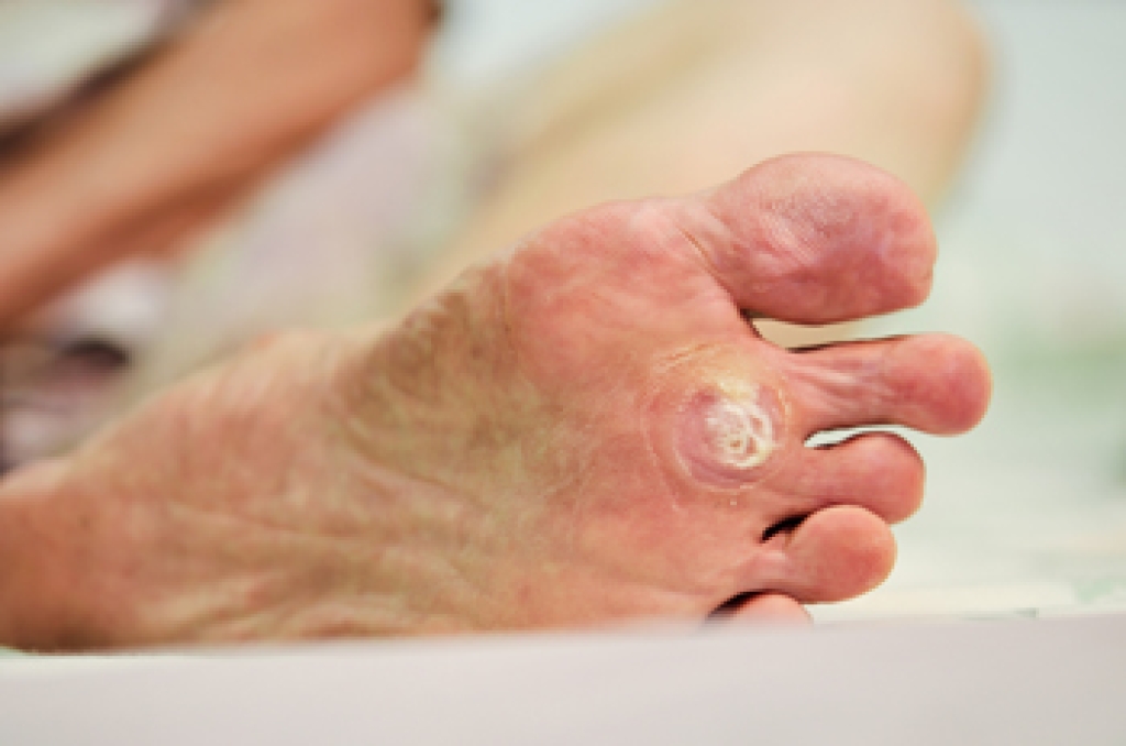 How to Recognize a Plantar Wart