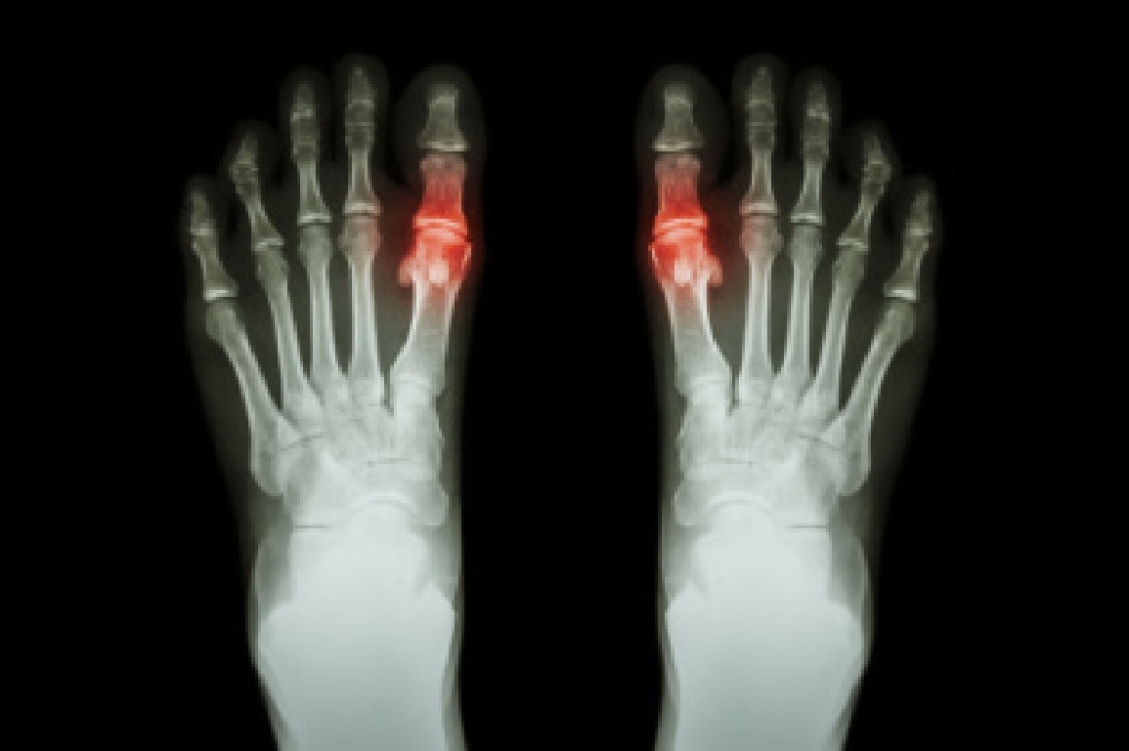 Understanding Gout and the Foods to Avoid
