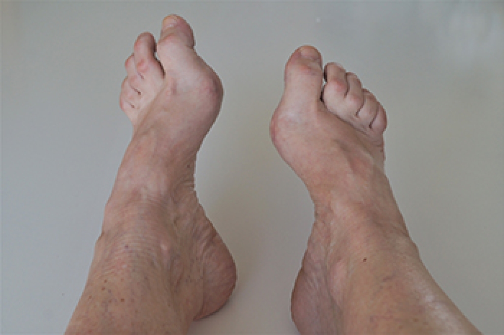 Warning Signs of Common Foot Deformities
