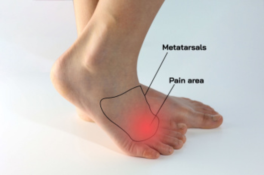 Morton’s Neuroma Can Make Walking Painful