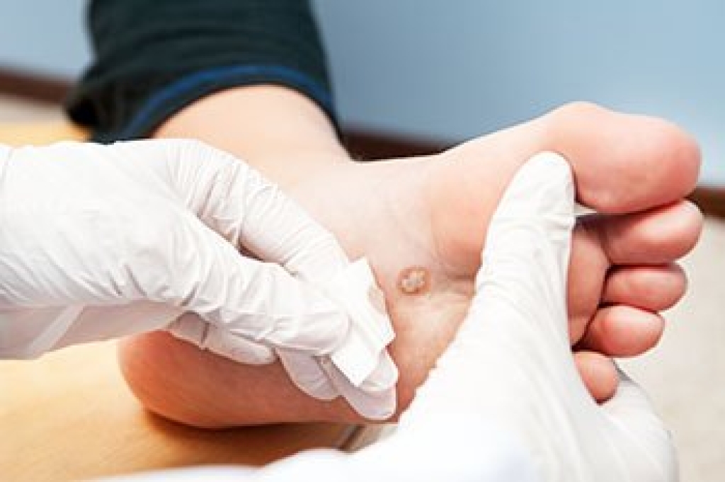 Recognizing Plantar Warts and Their Impact on Foot Health