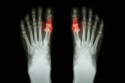 Understanding Gout and the Foods to Avoid