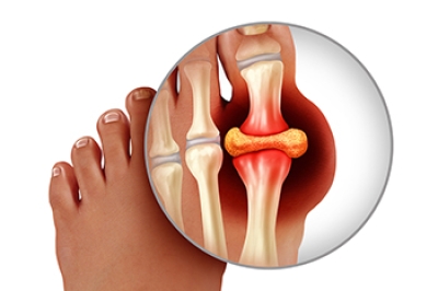 Gout and Its Link to Kidney Disease